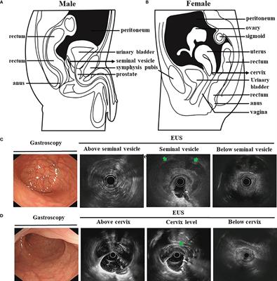 How Useful Is Endoscopic Ultrasound in Differentiating T3/T4a T Stage of Colorectal Cancer: A Prospective Study